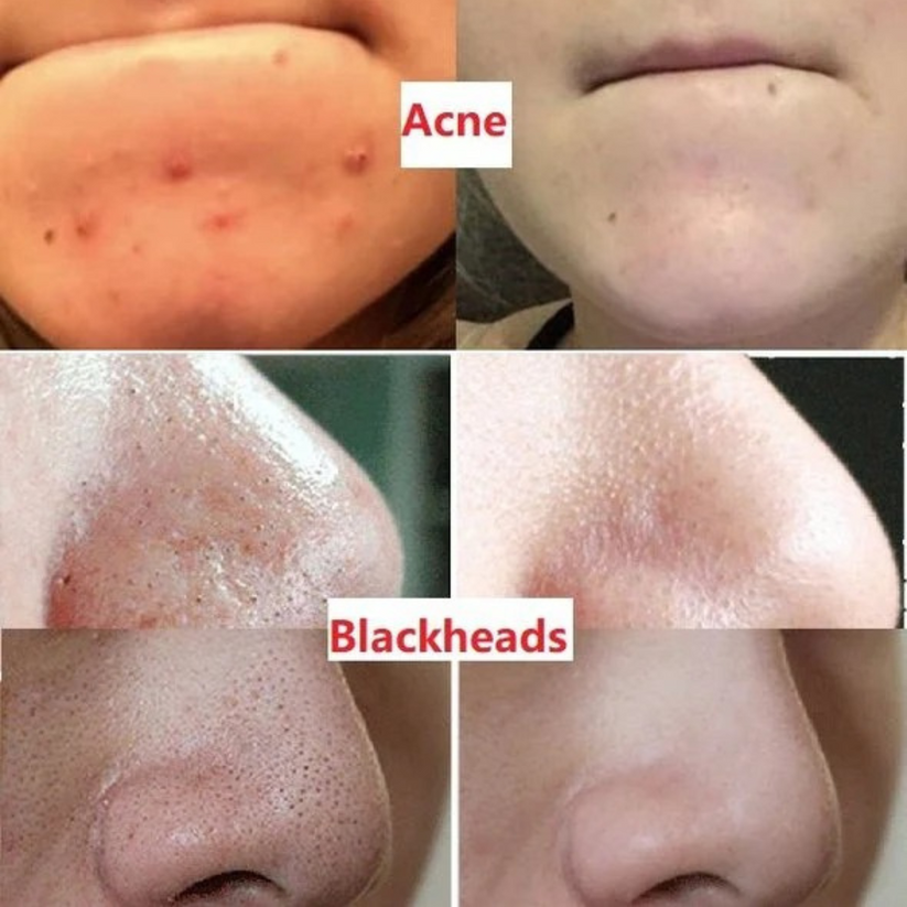 Deep Clean. Clear Pores.