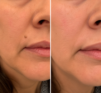 ✨Celviron 2‑in‑1 Microneedle Patch，Remove Skin Tags, Moles, Warts for Face & Body