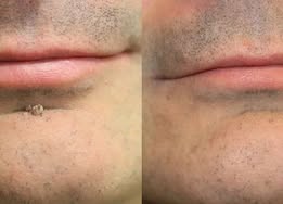✨Celviron 2‑in‑1 Microneedle Patch，Remove Skin Tags, Moles, Warts for Face & Body
