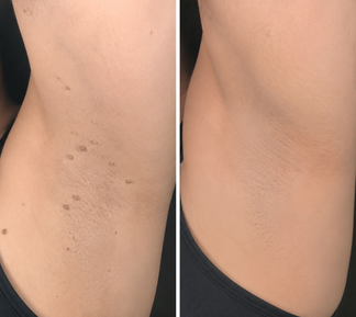 ✨Celviron 2‑in‑1 Microneedle Patch，Remove Skin Tags, Moles, Warts for Face & Body
